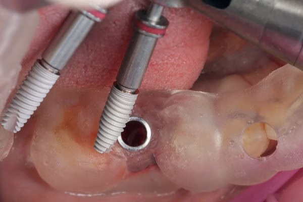 restauración de sonrisa